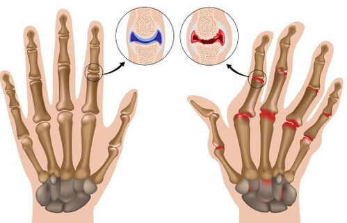 Arthritis and its symptoms