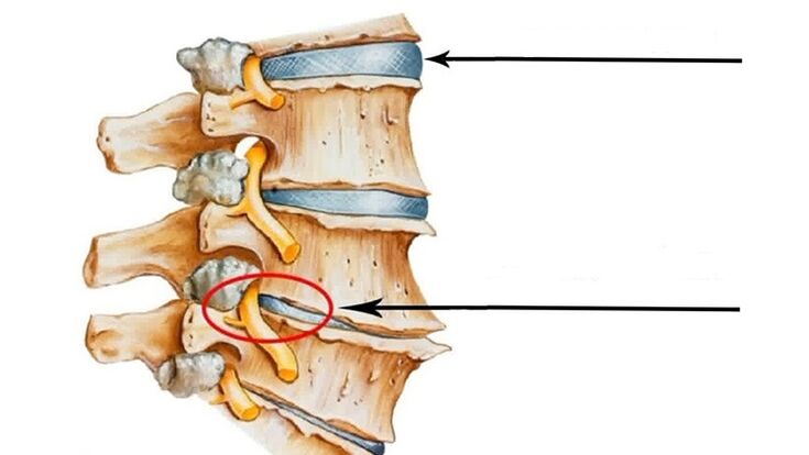 Spinal trauma in cases of cervical osteonecrosis