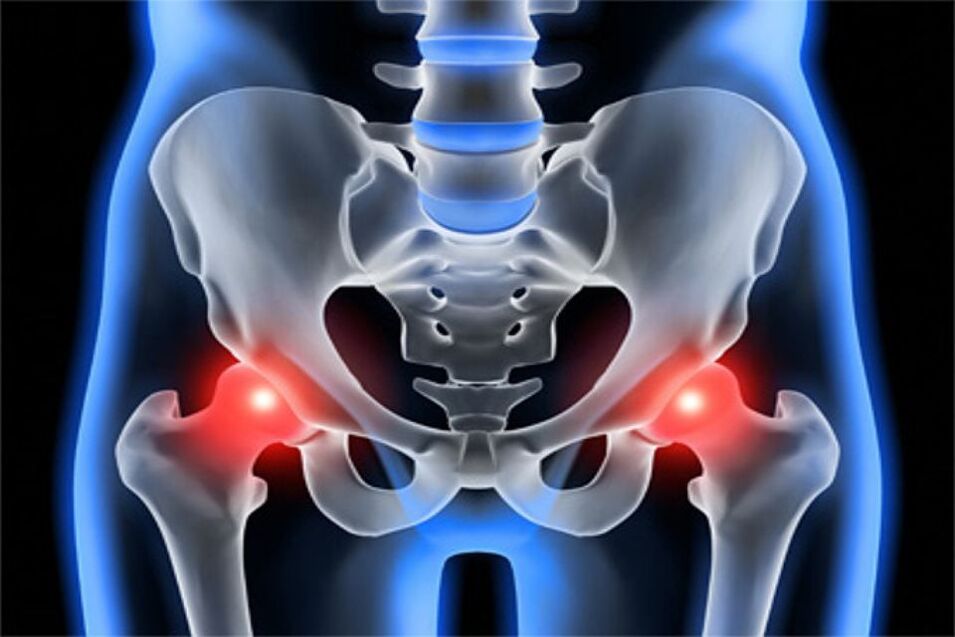 Deformity of the hip (coxarthrosis)