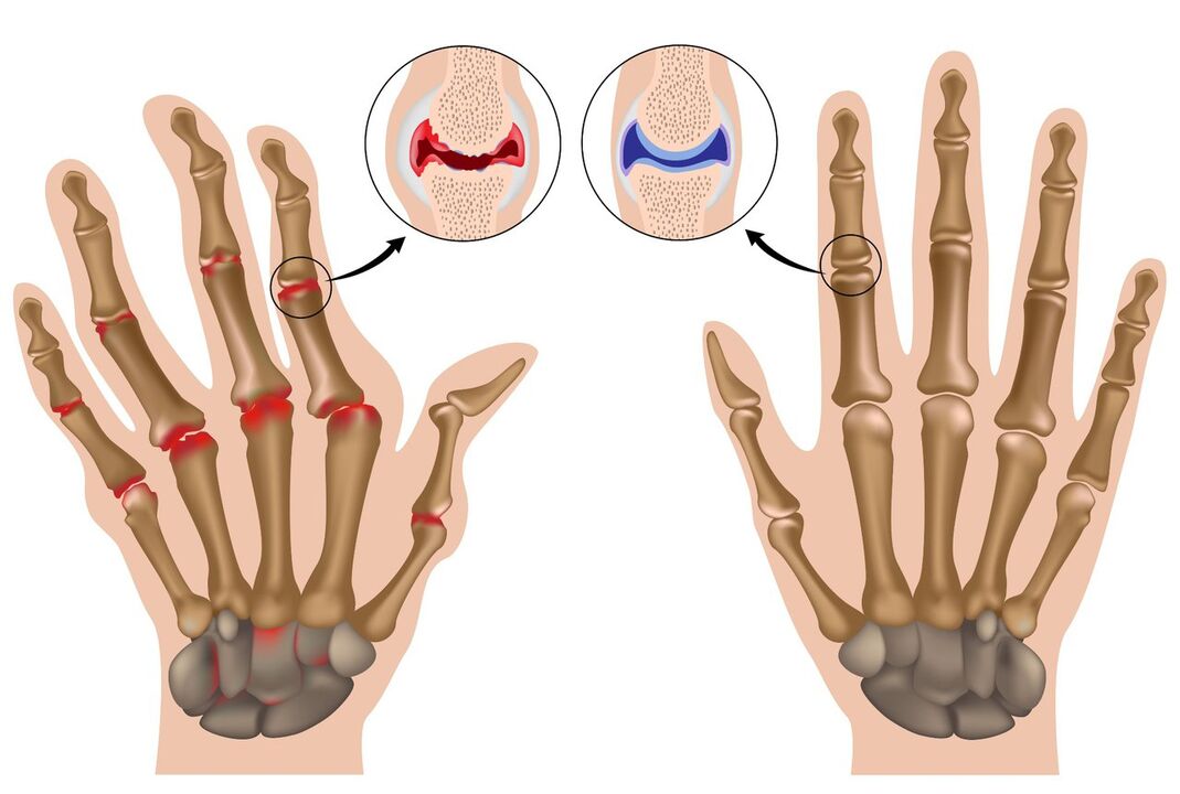 Hand joints are healthy and affected by polyarthritis