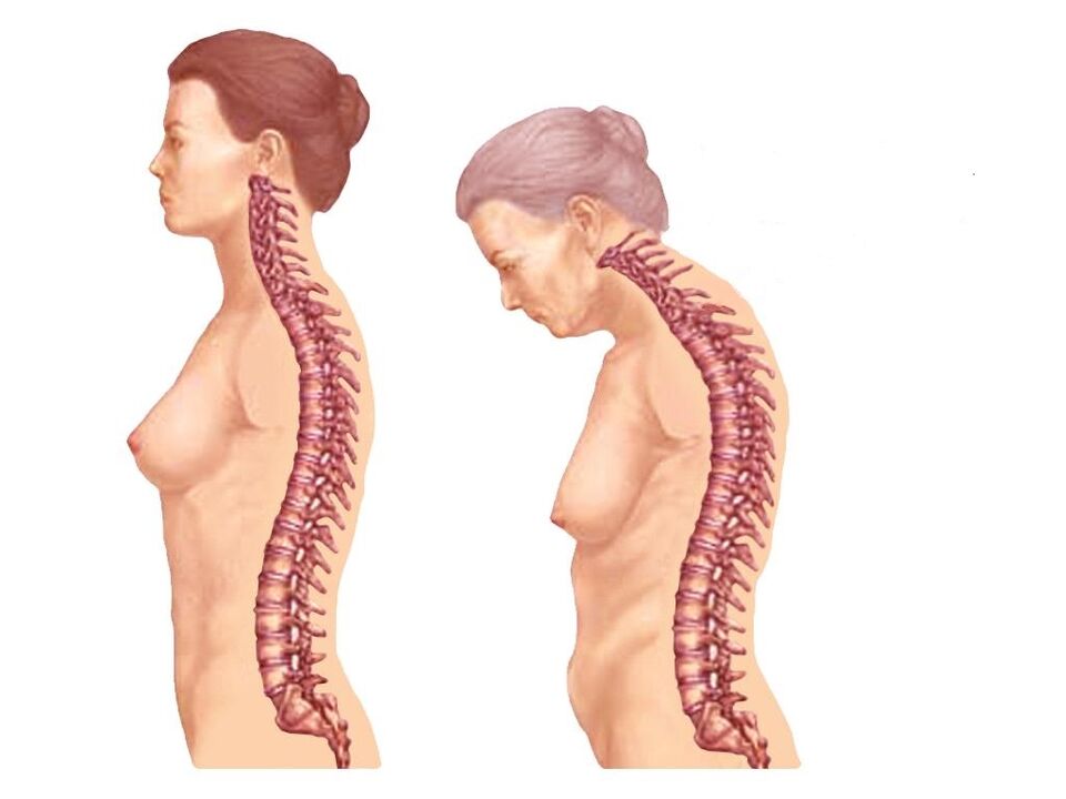 Healthy curved spine with osteoarthritis
