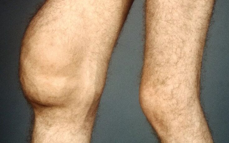 Post office -knee joints