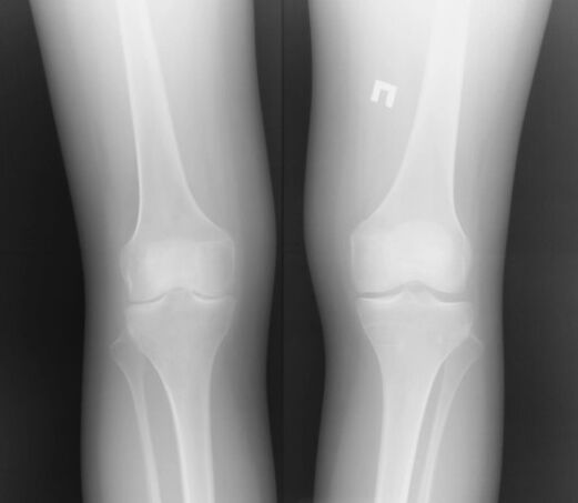 X -ray of the knee joint