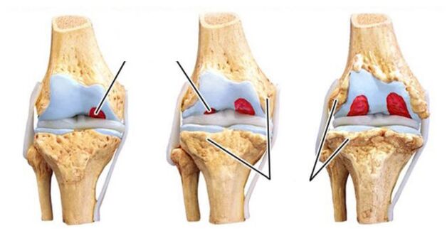 Complications of arthritis