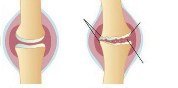 Wash cartilage