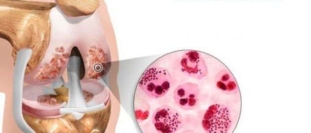 leading to the development of arthritis