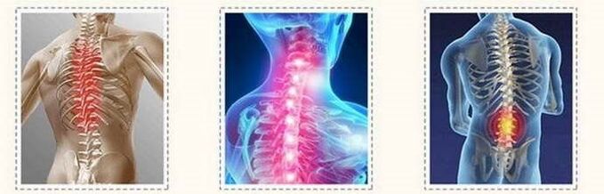 Bone spine damage