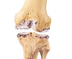 Knee joint damage due to arthritis