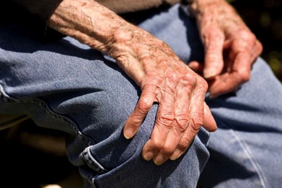 Osteoarthritis is an age-related disease that occurs in older people