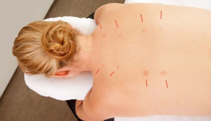Acupuncture treatment of thoracic spondylosis has many advantages